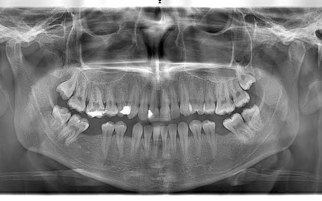 Panoramic X-Ray – Diş hekimi Ali Ziya Tunçel